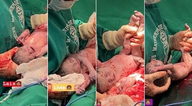 Até nascimento de bebê 'surpresa' que viralizou, AM não registrava casos de quadrigêmeos desde 99