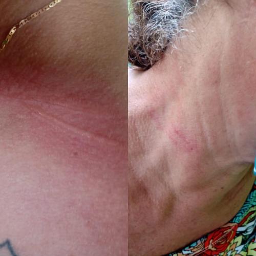 Linha de cerol atinge pescoço de professora da Ufam Parintins 
