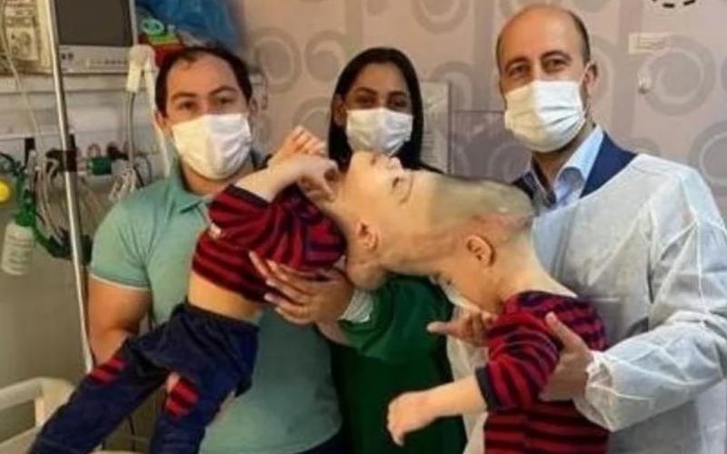 Siameses filhos de pais roraimense são separados após 27 horas de cirurgia Siameses filhos de pais roraimense são separados após 27 horas de cirurgia