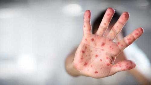 Brasil confirma 744 casos de sarampo