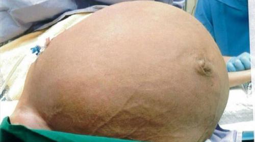 Médicos removem tumor gigante do útero de mulher de 53 anos 